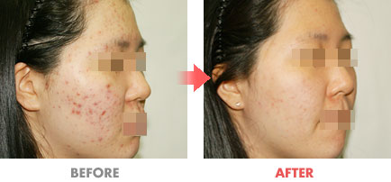 여드름 치료 전후사진