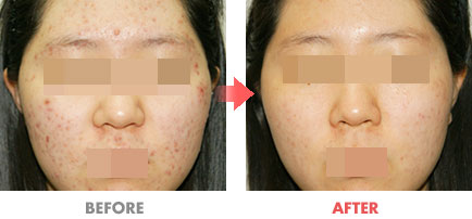 여드름 치료 전후사진