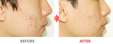 여드름 치료 전후사진